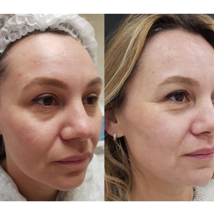 Процедура "Татуаж верхних век" (без выведения стрелки) 