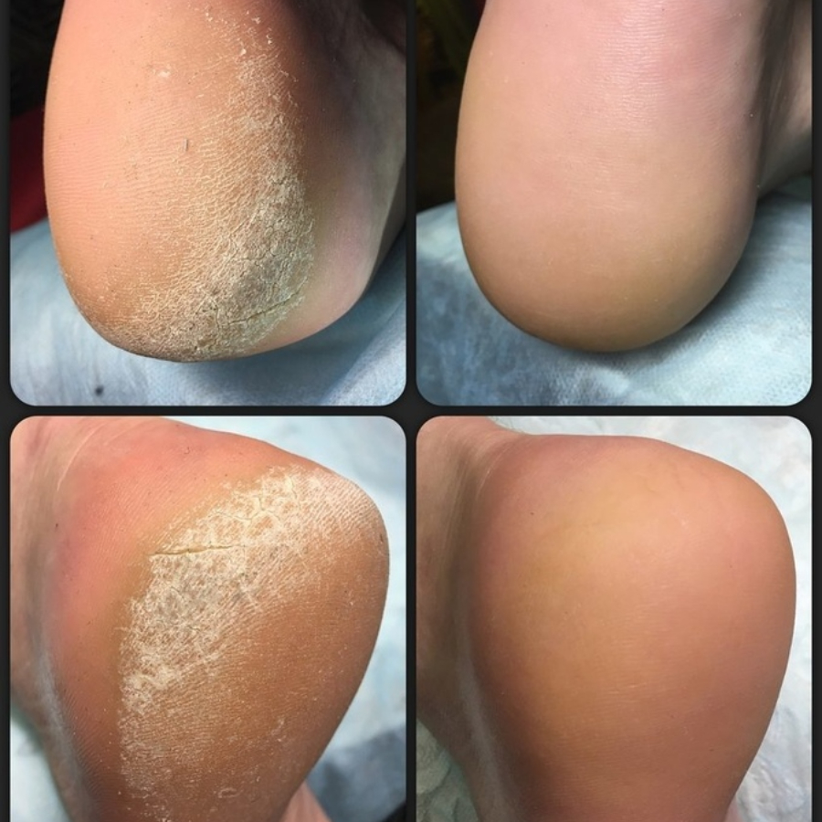 Педикюр мужской классический