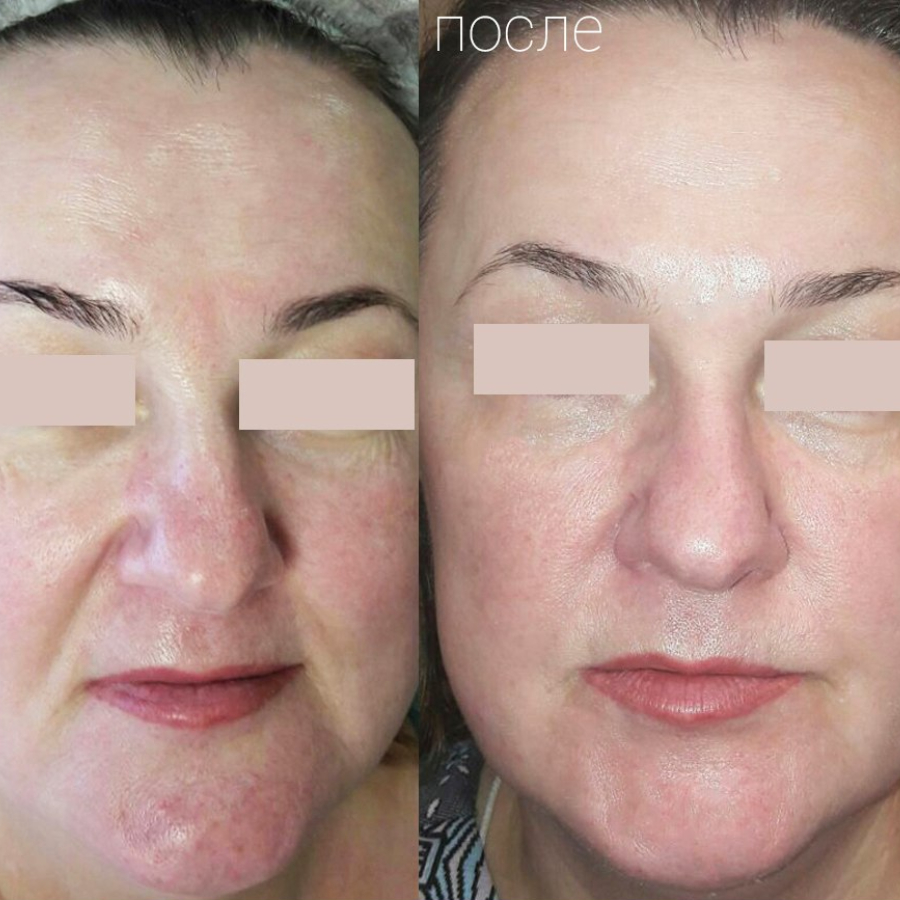 Процедура "Микротоковая терапия по лицу"